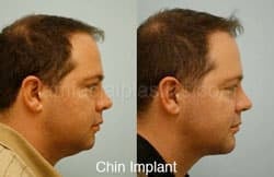Chin Augmentation Before & After