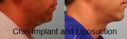 Chin Augmentation Before & After
