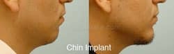 Chin Augmentation Before & After