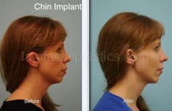 Chin Augmentation Before & After