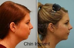 Chin Augmentation Before & After