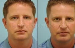 Chin Augmentation Before & After