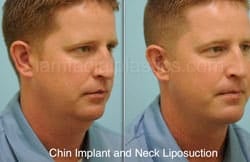 Chin Augmentation Before & After