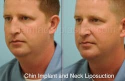 Chin Augmentation Before & After