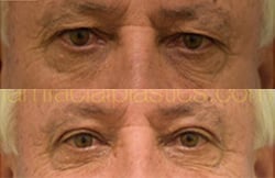 Eyelid Lift Before & After