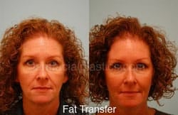 Fat Grafting Before & After