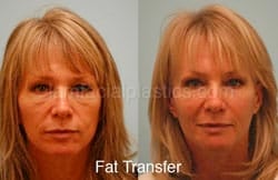Fat Grafting Before & After