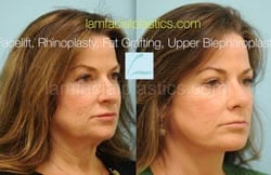 Fat Grafting Before & After