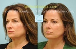 Fat Grafting Before & After