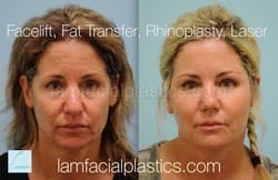 Fat Grafting Before & After
