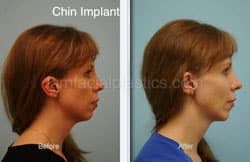 Fat Grafting Before & After