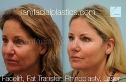 Fat Grafting Before & After