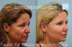 Fat Grafting Before & After