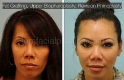 Fat Grafting Before & After