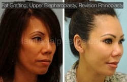 Fat Grafting Before & After