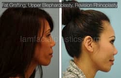 Fat Grafting Before & After
