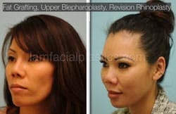 Fat Grafting Before & After