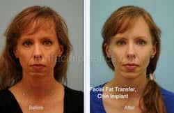 Fat Grafting Before & After