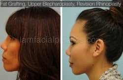 Fat Grafting Before & After