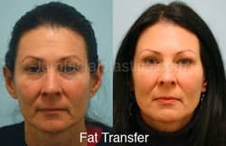 Fat Grafting Before & After