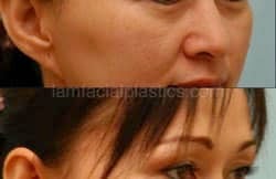 Fat Grafting Before & After
