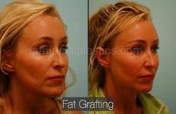Fat Grafting Before & After