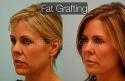 Fat Grafting Before & After