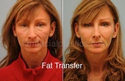Fat Grafting Before & After