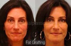 Fat Grafting Before & After