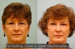 Fat Grafting Before & After