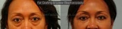 Fat Grafting Before & After