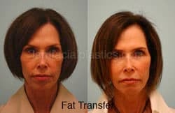 Fat Grafting Before & After