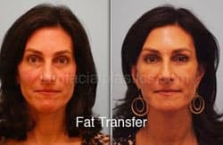Fat Grafting Before & After