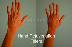 Fillers Before & After