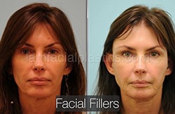 Fillers Before & After