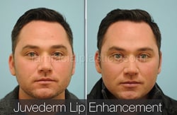 Fillers Before & After