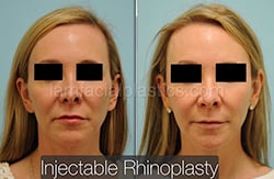 Fillers Before & After