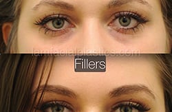 Fillers Before & After