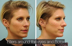 Fillers Before & After