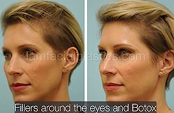 Fillers Before & After