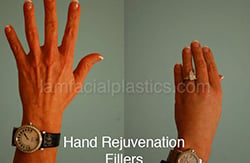 Fillers Before & After