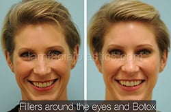 Fillers Before & After