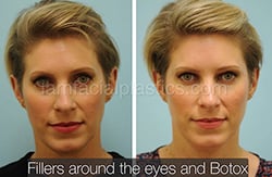 Fillers Before & After