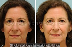 Fillers Before & After