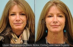 Fillers Before & After