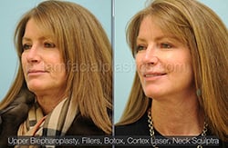 Fillers Before & After