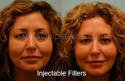 Fillers Before & After