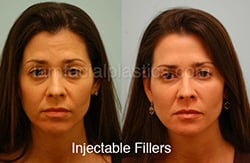Fillers Before & After