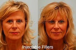 Fillers Before & After