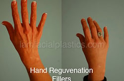 Fillers Before & After